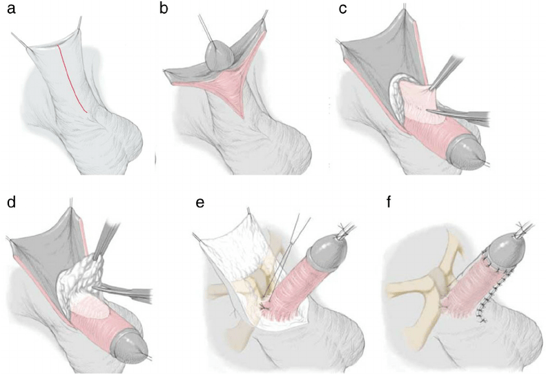 Ligamentotomy for Penile Enlargement